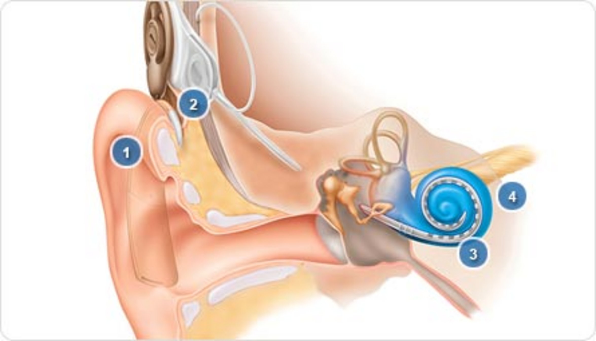 UKM HNO | Grafik Cochlea-Implantat