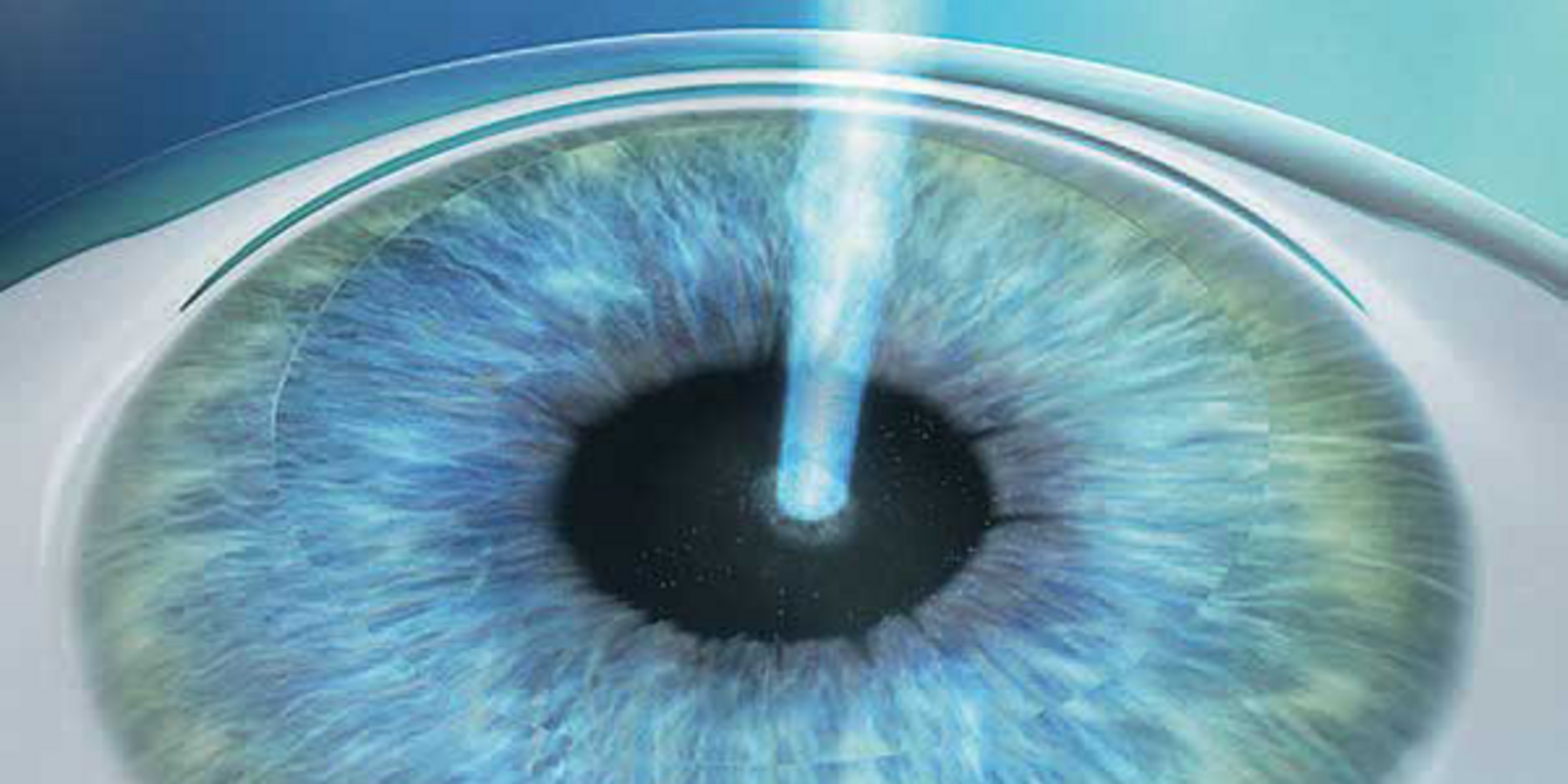 UKM Augenklinik | Augenlasern | PRK