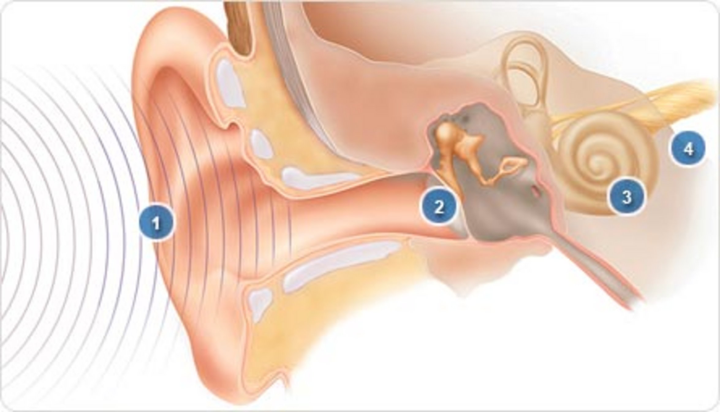 UKM HNO | Grafik Cochlea-Implantat
