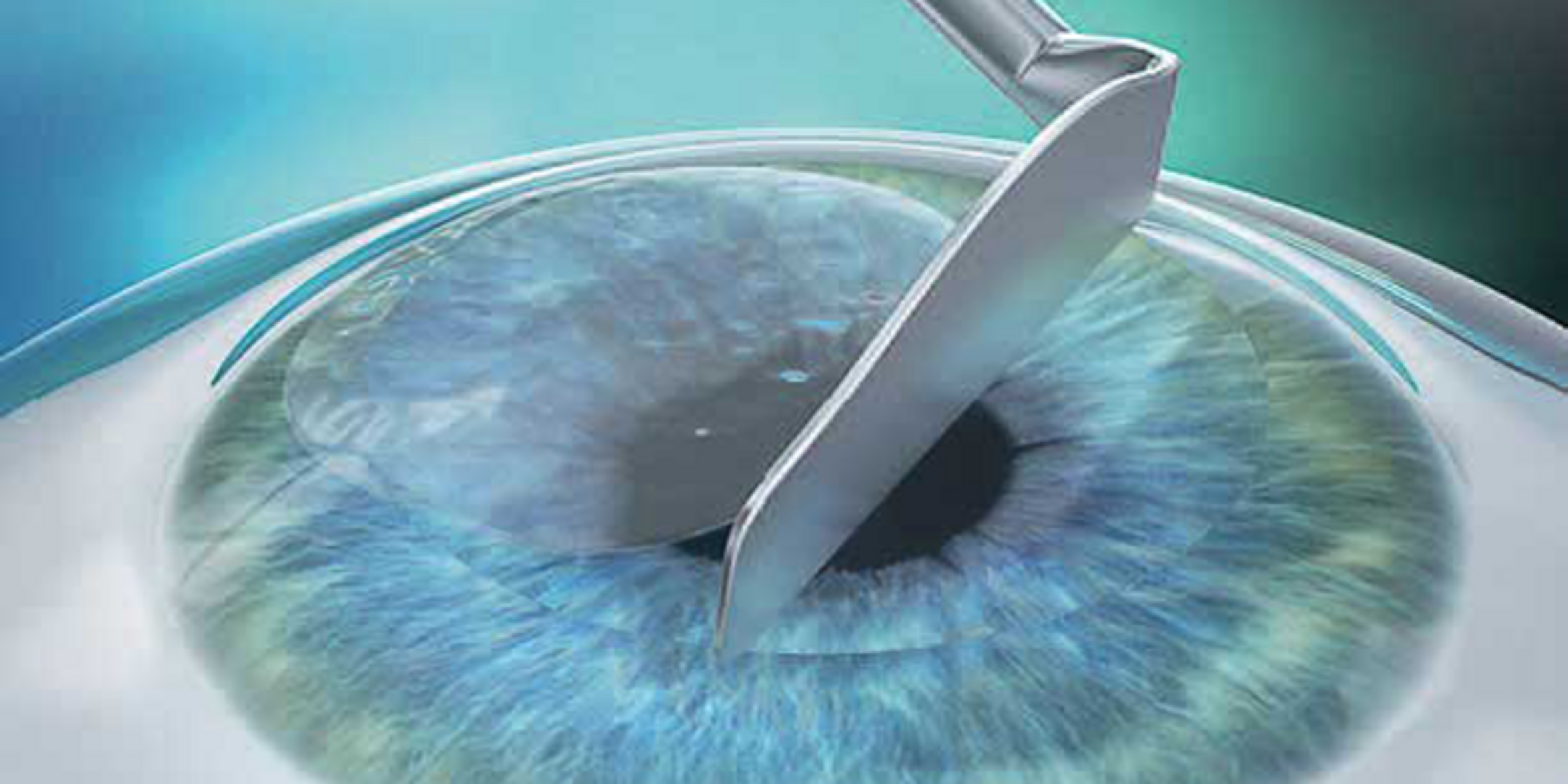 UKM Augenklinik | Augenlasern | LASEK