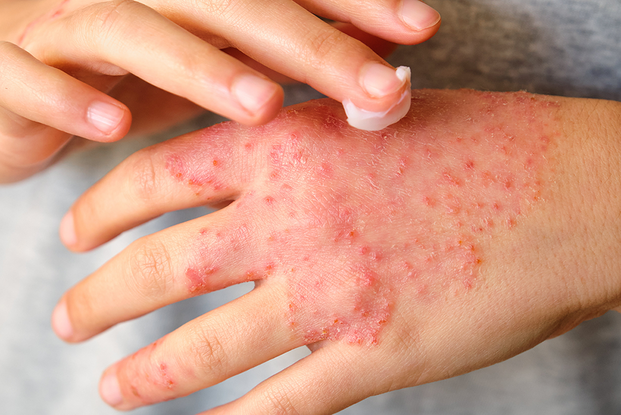 UKM Allergiezentrum Nord-West | Allergologische Erkrankungen